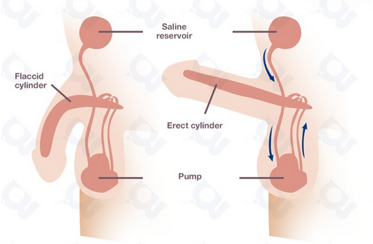 Erectile Dysfunction Surgery in India Cost Hospitals Doctor